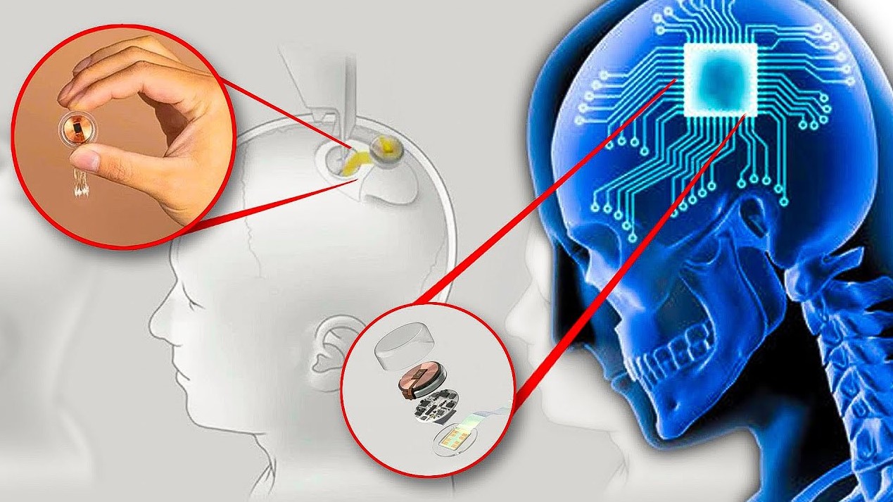 Musk Says Neuralink To Start Human Trial Of Brain Implant