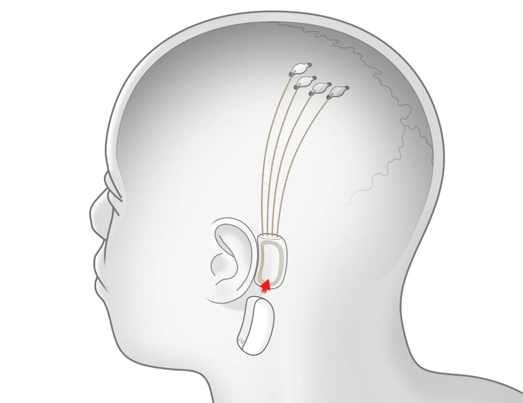 How Much Will Neuralink Cost