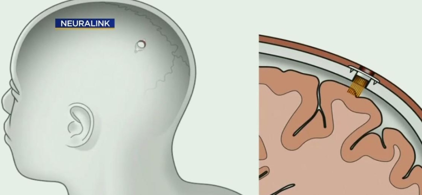 Neuralink Brain Implant